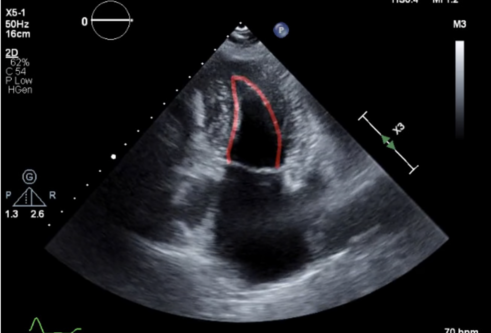 Image shows an area of abnormality detected in a echocardiography heart scan. Credit Us2.ai